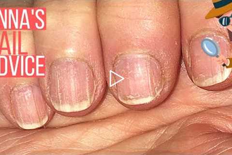 How To Care For Ridgy Nails  [ANNA'S NAIL ADVICE] 🕵️‍♀️