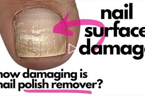 How Damaging Is Nail Polish Remover/Acetone?!  [Surprise, Surprise!]