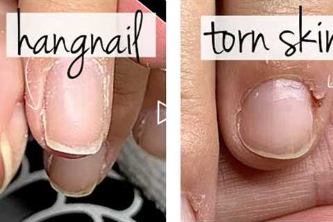 Hangnail or Torn Skin? [What's the Difference?]