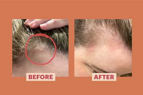 My Scalp Psoriasis Came Out of Nowhere — Here's How I Treated It